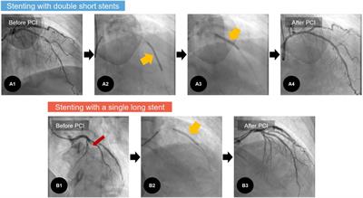 Comparative treatment outcomes of a single long stent vs. overlapped short stents in acute myocardial infarction